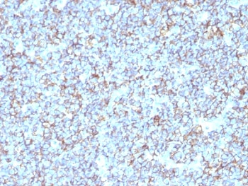 IHC: Formalin-fixed, paraffin-embedded human Ewing's sarcoma stained with anti-CD99 antibody (SPM596).