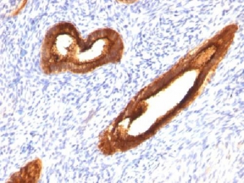 Formalin-fixed, paraffin-embedded human endometrial carcinoma stained with MUC1 antibody (MUC1/520).