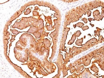 Formalin-fixed, paraffin-embedded human breast carcinoma stained with MUC1 antibody (MUC1/520).