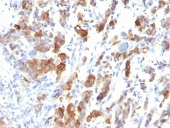 Immunohistochemistry analysis of MUC5AC in human gastric carcinoma tissue. Formalin-fixed, paraffin-embedded human gastric carcinoma tissue was stained using MUC5AC antibody (clone MUC5AC/917), showing cytoplasmic and luminal staining in tumor epithelial cells, consistent with mucin expression in gastric-type epithelium. Heat-mediated antigen retrieval was performed by boiling sections in pH 9 Tris-EDTA buffer for 10-20 minutes, followed by cooling at room temperature for 20 minutes. Detection was achieved using an HRP-based system with DAB chromogen, with hematoxylin counterstain.