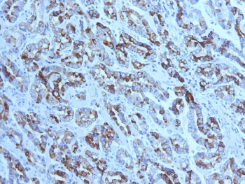 IHC testing of FFPE human gastric carcinoma with MUC6 antibody (clone CLH5). HIER: steam section in pH6 citrate buffer for 20 min and allow to cool prior to testing. Image courtesy of Dr. Leonor David, IPATIMUP and Medical Faculty, University of Porto, Portugal.