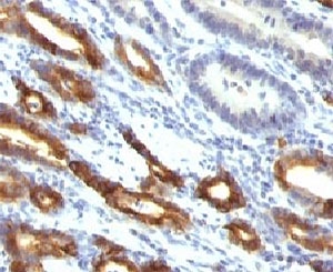 IHC: Formalin-fixed, paraffin-embedded human gastric carcinoma stained with Mucin-6 antibody (MUC6/916).