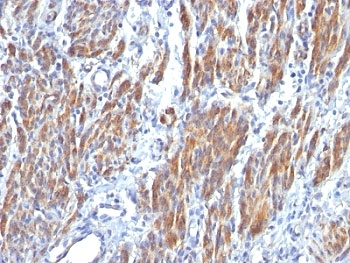 SM-MHC Antibody SMMS-1 Leiomyosarcoma IHC. Immunohistochemical staining of formalin fixed, paraffin embedded human leiomyosarcoma demonstrates Smooth Muscle Myosin Heavy Chain expression using SM-MHC Antibody clone SMMS-1. SMMHC, encoded by the MYH11 gene, is a highly specific marker of differentiated smooth muscle cells and a major component of the contractile apparatus. Strong cytoplasmic staining is observed throughout intersecting fascicles of spindle-shaped tumor cells, consistent with smooth muscle lineage and supporting the diagnosis of leiomyosarcoma. The characteristic staining pattern highlights the value of clone SMMS-1, a well-characterized antibody with extensive literature support, for identifying smooth muscle neoplasms and distinguishing them from other spindle cell tumors. These findings demonstrate the utility of SM-MHC Antibody SMMS-1 for studies of tumor pathology, smooth muscle differentiation, and contractile protein expression.