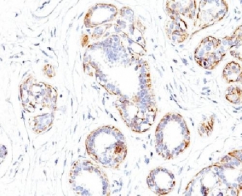 SM-MHC Antibody SMMS-1 Breast Carcinoma IHC. Immunohistochemical staining of FFPE human breast carcinoma demonstrates Smooth Muscle Myosin Heavy Chain expression using SM-MHC Antibody clone SMMS-1. SMMHC, encoded by the MYH11 gene, is a highly specific marker of myoepithelial and smooth muscle differentiation. Distinct cytoplasmic staining outlines residual myoepithelial cells surrounding ductal structures, while adjacent stromal elements show minimal reactivity. Preservation of this SMMHC-positive layer is valuable for distinguishing noninvasive lesions from invasive carcinoma. Clone SMMS-1, which has been cited extensively in the literature, provides reliable detection of MYH11 expression in breast tissue. These findings support the utility of SM-MHC Antibody SMMS-1 for studies of breast pathology, myoepithelial biology, and smooth muscle differentiation.