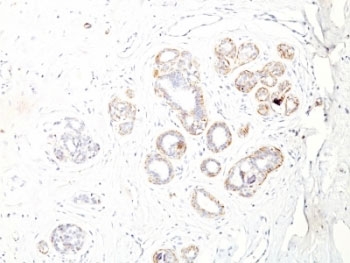 IHC: Formalin-fixed, paraffin-embedded human breast carcinoma stained with SM-MHC Antibody ID8.