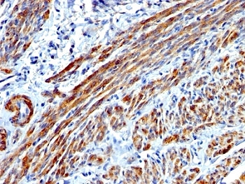 SMMHC Antibody Leiomyosarcoma IHC. Immunohistochemical staining of formalin fixed, paraffin embedded human leiomyosarcoma demonstrates Smooth Muscle Myosin Heavy Chain expression using SMMHC antibody clone MYH11/923. SMMHC, encoded by the MYH11 gene, is a highly specific marker of mature smooth muscle differentiation and an essential component of the contractile apparatus. Strong cytoplasmic staining is observed throughout intersecting fascicles of spindle-shaped tumor cells, consistent with smooth muscle lineage and supporting the diagnosis of leiomyosarcoma. Vascular smooth muscle elements are also prominently labeled. These findings demonstrate the utility of SMMHC Antibody for studies of smooth muscle neoplasms, tumor classification, and differentiation markers in surgical pathology.