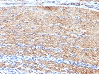 IHC: Formalin-fixed, paraffin-embedded human colon carcinoma stained with SMMHC antibody (MYH11/923 + SMMS-1).