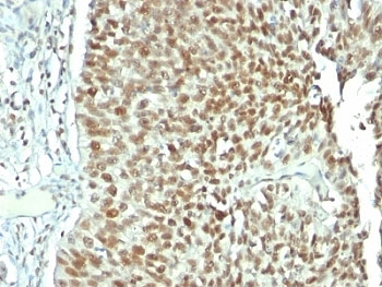 IHC: Formalin-fixed, paraffin-embedded human bladder carcinoma stained with Nucleolin antibody.