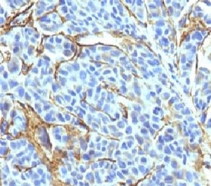 IHC: Formalin-fixed, paraffin-embedded human melanoma stained with NGFR antibody (NTR/912).