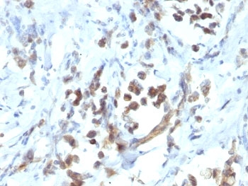 PAX6 Antibody Gastric Carcinoma IHC. Immunohistochemical staining of formalin fixed, paraffin embedded human gastric carcinoma demonstrates PAX6 expression using PAX6 antibody clone PAX6/1166. PAX6 is a highly conserved transcription factor that regulates cellular differentiation and developmental programs and is essential for eye and nervous system development. Predominantly nuclear staining is observed in malignant epithelial cells, consistent with the role of PAX6 as a DNA binding protein involved in transcriptional regulation. These findings support the utility of PAX6 Antibody for studies of developmental signaling, stem cell biology, and cancer progression.