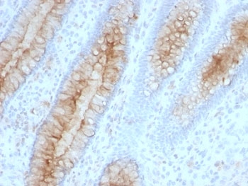 IHC: Formalin-fixed, paraffin-embedded human colon carcinoma stained with Beta-2-Microglobulin antibody (B2M/961).