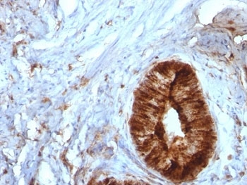 IHC: Formalin-fixed, paraffin-embedded human cervical carcinoma stained with Beta-2-Microglobulin antibody (clone B2M/961).