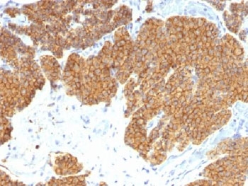 Parathyroid Hormone Antibody Clone 3H9 immunohistochemistry of human parathyroid gland. FFPE human parathyroid tissue stained with Parathyroid Hormone Antibody Clone 3H9, a mouse monoclonal antibody recognizing Parathyroid hormone (PTH). Strong cytoplasmic brown chromogenic staining is observed in parathyroid endocrine chief cells, consistent with the known intracellular localization of Parathyroid hormone in hormone-producing cells of the parathyroid gland.