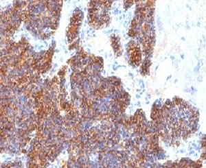 PTH Antibody C Terminus immunohistochemistry of human parathyroid gland. FFPE human parathyroid tissue stained with PTH Antibody C Terminus clone PTH/1173, a mouse monoclonal antibody recognizing the C-terminal region of Parathyroid hormone (PTH). Strong cytoplasmic brown chromogenic staining is observed in parathyroid endocrine chief cells, consistent with the expected intracellular localization of Parathyroid hormone in hormone-producing cells of the parathyroid gland.