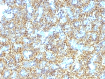 PTH Antibody Immunohistochemistry analysis of Parathyroid hormone in human parathyroid tissue. FFPE human parathyroid tissue was stained using PTH antibody clone PTH/1174 following heat induced epitope retrieval prior to staining. HRP-DAB brown chromogenic signal highlights strong cytoplasmic staining in parathyroid endocrine chief cells arranged in nests and cords, consistent with the known expression of Parathyroid hormone (PTH), a key regulator of calcium homeostasis produced by parathyroid gland cells. The staining pattern demonstrates robust detection of hormone-producing endocrine tissue and supports the use of PTH Antibody Immunohistochemistry / Parathyroid Hormone (clone PTH/1174) for immunohistochemistry analysis of PTH expression in FFPE tissue sections.