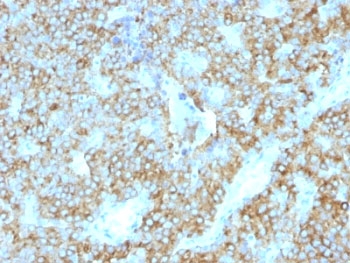 PTH Antibody for IHC immunohistochemistry analysis of Parathyroid hormone in human parathyroid tissue. FFPE human parathyroid tissue was stained using PTH antibody clone PTH/1175 following heat induced epitope retrieval prior to staining. HRP-DAB brown chromogenic signal highlights strong cytoplasmic staining in parathyroid endocrine cells arranged in nests and cords, consistent with the known expression of Parathyroid hormone (PTH) in hormone-producing chief cells that regulate systemic calcium homeostasis. This staining pattern demonstrates robust detection of parathyroid endocrine tissue and supports the use of PTH Antibody for IHC / Parathyroid Hormone Antibody (clone PTH/1175) for immunohistochemistry analysis of PTH expression in human tissue sections.