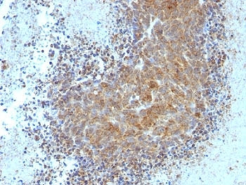 IHC: Formalin-fixed, paraffin-embedded human melanoma stained with Bax antibody (clone BAX/962).