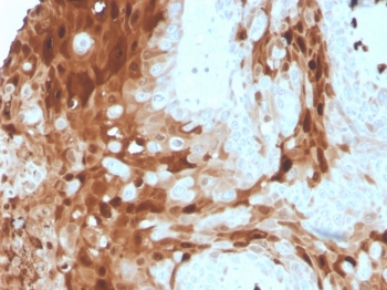 IHC staining of FFPE human breast cancer tissue with S100A9 antibody (clone S100A9/1075). HIER: boil tissue sections in pH 9 10mM Tris with 1mM EDTA for 20 min and allow to cool before testing.