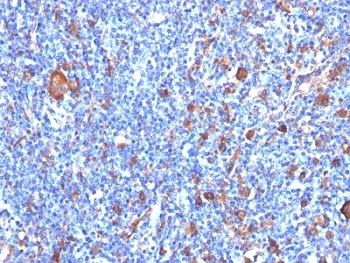 IHC: Formalin-fixed, paraffin-embedded human Hodgkin's lymphoma stained with Fascin antibody (clone FSCN1/417).