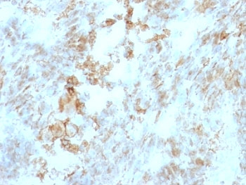 IHC: Formalin-fixed, paraffin-embedded human colon carcinoma stained with CD147 antibody (BSG/963).