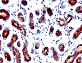 TFF1 Antibody Mouse Monoclonal Clone TFF1/1091. Immunohistochemistry analysis of Trefoil factor 1 (TFF1) in formalin-fixed, paraffin-embedded human breast carcinoma tissue using TFF1 Antibody Mouse Monoclonal Clone TFF1/1091. Tumor epithelial cells show HRP-DAB brown cytoplasmic staining consistent with expression of the estrogen regulated secretory peptide TFF1 (pS2). Hematoxylin counterstain highlights nuclei (blue).