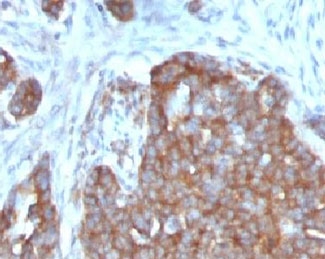 TFF1 Antibody Mouse Monoclonal Clone TFF1/1091. Immunohistochemistry analysis of Trefoil factor 1 (TFF1) in formalin-fixed, paraffin-embedded human ovarian carcinoma tissue using TFF1 Antibody Mouse Monoclonal Clone TFF1/1091. Tumor epithelial cells demonstrate HRP-DAB brown cytoplasmic staining consistent with expression of the estrogen regulated secretory peptide TFF1 (pS2). Hematoxylin counterstain highlights nuclei (blue).