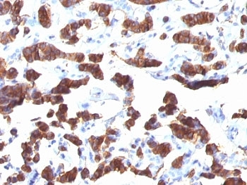 Thyroglobulin Antibody / TG Thyroid Hormone Precursor Protein Antibody (clone TGB24). Immunohistochemistry analysis of human thyroid carcinoma tissue. FFPE human thyroid carcinoma sections demonstrate strong HRP-DAB brown cytoplasmic staining in tumor epithelial cells arranged in follicular and gland-like structures, consistent with thyroglobulin production by differentiated thyroid follicular cells. Intense brown chromogenic signal is also observed within luminal colloid material, reflecting the accumulation of this thyroid hormone precursor protein secreted by follicular epithelial cells. Tumor cell cytoplasm shows diffuse granular positivity, while surrounding stromal elements exhibit minimal staining. Nuclear hematoxylin counterstain is visible in blue. Heat induced epitope retrieval was performed in 10 mM Tris with 1 mM EDTA, pH 9.0, by boiling tissue sections for 10-20 minutes followed by cooling at room temperature for 20 minutes prior to antibody incubation.