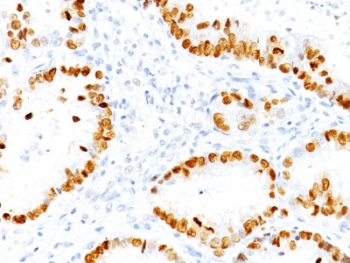 Immunohistochemistry of TTF-1 Antibody / Thyroid Tumor Marker Antibody in human lung adenocarcinoma. Formalin-fixed, paraffin-embedded human lung adenocarcinoma stained using TTF-1 Antibody / Thyroid Tumor Marker Antibody. The mouse monoclonal clone NX2.1/690 antibody demonstrates strong nuclear staining in malignant pulmonary epithelial cells, consistent with the nuclear localization of Thyroid transcription factor 1 (NKX2-1). Nuclear TTF-1 expression is a characteristic feature of many pulmonary adenocarcinomas and is widely used in diagnostic immunohistochemistry to support identification of tumors of pulmonary epithelial origin. Because NKX2-1 is expressed in both pulmonary epithelium and thyroid follicular cells, TTF-1 antibody staining is commonly included in tumor marker panels used to distinguish primary lung adenocarcinoma from metastatic carcinomas involving the lung.