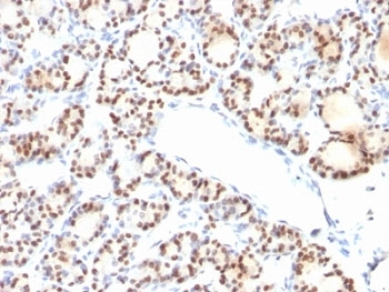 Immunohistochemistry of TTF-1 Antibody / Thyroid Tumor Marker Antibody in human thyroid tissue. Formalin-fixed, paraffin-embedded human thyroid tissue stained using TTF-1 Antibody / Thyroid Tumor Marker Antibody. The mouse monoclonal clone NX2.1/690 antibody shows strong nuclear staining in thyroid follicular epithelial cells lining the thyroid follicles. Nuclear immunoreactivity for Thyroid transcription factor 1 (NKX2-1) is characteristic of thyroid follicular epithelium and supports the use of this antibody as a thyroid tumor marker in immunohistochemistry. This staining pattern highlights thyroid epithelial lineage and reflects the established role of TTF-1 as a diagnostic marker used in endocrine pathology to identify thyroid follicular tumors and thyroid carcinoma in surgical pathology panels.