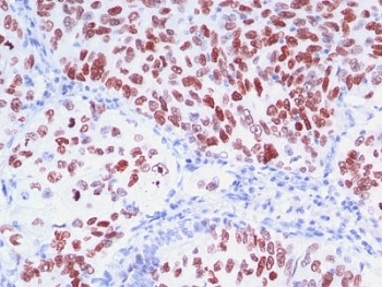 Immunohistochemistry of TTF-1 Antibody / Lung and Thyroid Diagnostic Marker Antibody in human lung carcinoma. Formalin-fixed, paraffin-embedded human lung carcinoma stained using TTF-1 Antibody / Lung and Thyroid Diagnostic Marker Antibody. The mouse monoclonal clones 8G7G3/1 + NX2.1/690 antibodies demonstrate strong nuclear staining in malignant pulmonary epithelial cells, consistent with the nuclear localization of Thyroid transcription factor 1 (NKX2-1). Nuclear TTF-1 immunoreactivity is widely used in surgical pathology as a diagnostic marker for tumors of pulmonary epithelial origin, particularly pulmonary adenocarcinoma and small cell lung carcinoma. Because NKX2-1 expression is associated with epithelial cells of lung and thyroid lineage, TTF-1 antibody staining is routinely incorporated into immunohistochemistry tumor panels to assist in determining tumor origin and to help distinguish primary lung carcinoma from metastatic carcinomas involving the lung.