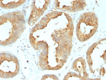 IHC analysis of formalin-fixed, paraffin-embedded human breast carcinoma tissue stained with GRP94 antibody (clone 9G10.F8.2). HIER: boil tissue sections in pH 9 10mM Tris with 1mM EDTA for 20 min and allow to cool before testing.