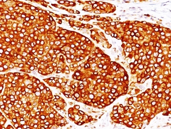 IHC: Formalin-fixed, paraffin-embedded melanoma stained with TYR antibody (clones T311 + OCA1/812).