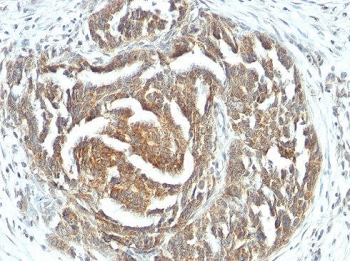 VEGF Antibody Human Ovarian Cancer IHC. Immunohistochemical staining of FFPE human ovarian carcinoma tissue using VEGF Antibody (clone VEGF/1063). An HRP-conjugated secondary antibody with DAB substrate was used for detection. VEGF Antibody / VEGFA demonstrates strong cytoplasmic staining in tumor cells, consistent with VEGFA expression associated with tumor angiogenesis, endothelial cell signaling, vascular remodeling, and regulation of the tumor microenvironment.