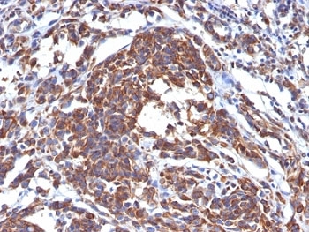 Vimentin Antibody Clone LN-6 IHC. Immunohistochemistry analysis of Vimentin / VIM in human melanoma tissue showing strong cytoplasmic staining in tumor cells, consistent with mesenchymal marker expression in melanoma. The mouse monoclonal antibody clone LN-6 highlights widespread cytoplasmic intermediate filament localization in malignant cells, while surrounding stromal elements also display expected Vimentin positivity. Hematoxylin counterstain (blue) provides nuclear contrast, and staining pattern aligns with the known mesenchymal phenotype and invasive characteristics of melanoma.