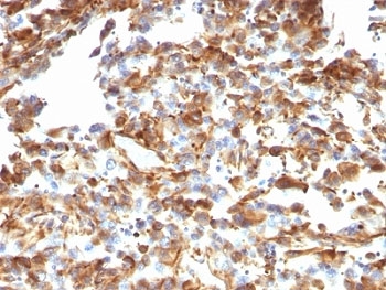Vimentin Antibody / Intracellular Transport Marker Antibody Melanoma IHC. Immunohistochemistry analysis of FFPE human melanoma tissue using Vimentin antibody shows strong HRP-DAB brown cytoplasmic staining in tumor-associated stromal cells and spindle-shaped mesenchymal populations, with variable staining in melanoma cells. The mouse monoclonal clone VM1170 highlights filamentous cytoplasmic networks distributed around the nucleus and extending throughout the cytoplasm, consistent with cytoskeletal organization involved in organelle positioning. The distribution of Vimentin-positive cells and subcellular pattern supports its role in intracellular organization and transport-associated cytoskeletal structure.