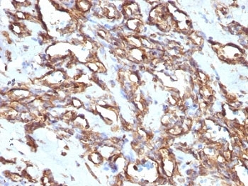 Vimentin Antibody Angiosarcoma IHC.  Immunohistochemistry analysis of formalin-fixed, paraffin-embedded human angiosarcoma stained with anti-Vimentin antibody (clone VM1170).