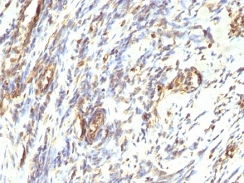 Vimentin Antibody Leiomyosarcoma IHC.  Immunohistochemistry analysis of formalin-fixed, paraffin-embedded human Leiomyosarcoma stained with anti-Vimentin antibody (clone VM1170).