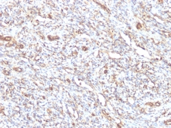 Vimentin Antibody / Intracellular Transport Marker Antibody Rhabdomyosarcoma IHC. Immunohistochemistry analysis of FFPE human rhabdomyosarcoma tissue using Vimentin antibody shows moderate to strong HRP-DAB brown cytoplasmic staining in tumor cells with spindle-shaped and pleomorphic morphology. The mouse monoclonal clone VM1170 highlights filamentous cytoplasmic structures distributed around the nucleus and extending through the cytoplasm, consistent with cytoskeletal organization associated with organelle positioning. The subcellular staining pattern supports the role of Vimentin in intracellular organization and transport-related cytoskeletal structure in tumor cells.