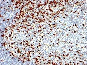 ZAP70 Antibody / Immune Tolerance Signaling Antibody. Immunohistochemistry analysis of formalin-fixed, paraffin-embedded human tonsil tissue using ZAP70 Antibody / Immune Tolerance Signaling Antibody (clone SPM362). Cytoplasmic HRP-DAB brown staining is observed in scattered lymphoid cell populations within tonsillar follicles and interfollicular regions, with variable staining intensity compared to surrounding cells. This pattern is consistent with Zeta-chain-associated protein kinase 70 (ZAP70) expression in lymphocytes and reflects regulated signaling states associated with immune tolerance and T-cell non-responsiveness. The distribution highlights subsets of lymphoid cells where signaling attenuation and tolerance mechanisms are active within the tissue microenvironment.