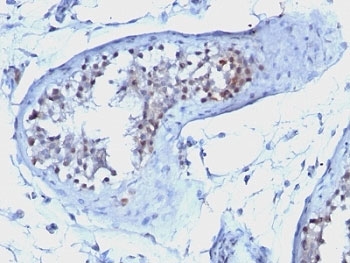 Cyclin B1 Antibody Testicular Carcinoma IHC. Immunohistochemistry staining of FFPE human testicular carcinoma tissue using Cyclin B1 Antibody / Cell Cycle Regulator Antibody demonstrates predominantly nuclear HRP-DAB brown staining within neoplastic cell populations. The staining pattern is consistent with Cyclin B1 expression in actively proliferating tumor cells undergoing cell cycle progression and mitotic regulation. Cyclin B1 functions as a critical regulator of the G2/M transition through activation of the Cyclin B1-CDK1 complex and is frequently used as a marker of cellular proliferation and mitotic activity in cancer tissues. The observed nuclear localization is consistent with the established role of Cyclin B1 in controlling cell cycle progression and promoting entry into mitosis.