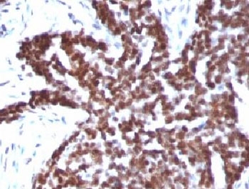 Cyclin B1 Antibody Ovarian Carcinoma IHC. Immunohistochemistry staining of FFPE human ovarian carcinoma tissue using Cyclin B1 Antibody / Cell Cycle Regulator Antibody demonstrates strong nuclear HRP-DAB brown staining throughout malignant epithelial cell populations. The staining pattern is consistent with elevated Cyclin B1 expression in actively proliferating tumor cells and highlights the role of Cyclin B1 as a central regulator of G2/M phase progression and mitotic entry. Cyclin B1 forms a functional complex with CDK1 to coordinate chromosome condensation, spindle assembly, and cell division, making it a widely utilized marker of cell cycle activity and proliferative status. The extensive nuclear staining observed in this ovarian carcinoma specimen is consistent with the increased proliferative activity characteristic of many malignant epithelial tumors.