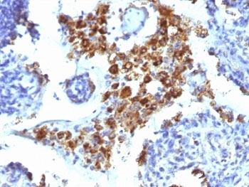 IHC: Formalin-fixed, paraffin-embedded human lung Adenocarcinoma stained with Napsin-A/NAPSA antibody (clone NAPSA/1238).