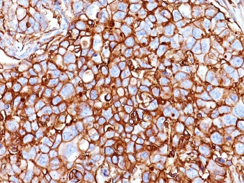 CD44 Antibody Breast Carcinoma IHC. Immunohistochemistry analysis of CD44 / CD44 antigen expression in FFPE human breast carcinoma tissue using Cancer Stem Cell Marker Antibody clone HCAM/918. Membranous HRP-DAB brown staining is observed in tumor epithelial cells, outlining cell borders and highlighting cell surface localization. The staining pattern demonstrates heterogeneous intensity across the tumor, with subsets of strongly positive cells within the broader population, consistent with enrichment of CD44-expressing subpopulations. This pattern supports its use for evaluating tumor heterogeneity, cellular organization, and identification of stem-like cell populations in breast carcinoma tissue.