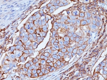 CD44 Antibody Breast Carcinoma IHC. Immunohistochemistry analysis of CD44 / CD44 antigen expression in FFPE human breast carcinoma using mouse monoclonal antibody clone DF1485. Membranous HRP-DAB brown staining is observed in tumor epithelial cells, outlining cell borders and highlighting cell surface localization consistent with CD44 expression. The staining pattern demonstrates heterogeneous intensity across tumor cells and supports its use for evaluating CD44 distribution and cellular organization in breast carcinoma tissue. Heat induced epitope retrieval was performed by boiling tissue sections in pH 9 10mM Tris with 1mM EDTA for 20 min followed by cooling at RT before testing.