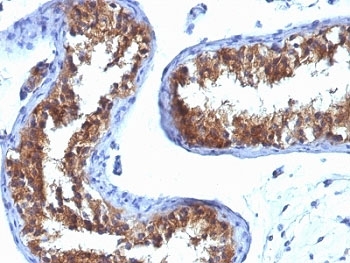 Major Vault Protein Antibody for IHC. Immunohistochemistry analysis of Major Vault Protein (MVP / LRP) expression in formalin-fixed, paraffin-embedded human testicular carcinoma using clone 1032 mouse monoclonal antibody. Tumor epithelial cells display strong cytoplasmic HRP-DAB brown staining with a granular to diffuse pattern, consistent with vault particle distribution, while surrounding stromal elements show minimal staining. The signal highlights malignant cell populations within glandular and solid tumor regions, supporting the role of Major vault protein in tumor biology and cellular stress response pathways.