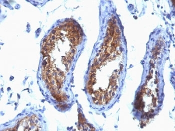 MVP Antibody Testicular Carcinoma IHC. Immunohistochemistry analysis of Major Vault Protein (MVP / LRP) expression in formalin-fixed, paraffin-embedded human testicular carcinoma using clone SPM280 mouse monoclonal antibody. Tumor epithelial cells display strong cytoplasmic HRP-DAB brown staining with a diffuse to granular pattern, while surrounding stromal regions show lower background signal. The staining highlights malignant cell populations within glandular tumor structures, consistent with elevated Major vault protein expression associated with drug resistance and cellular stress response pathways in cancer.