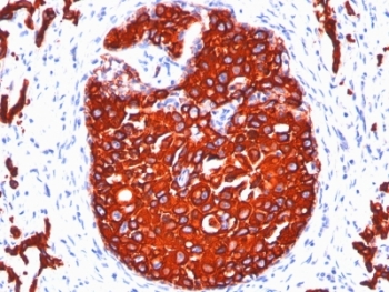 Pan Cytokeratin Antibody breast carcinoma IHC. Immunohistochemistry analysis of cytokeratin expression in FFPE human breast carcinoma tissue using Pan Cytokeratin antibody clones KRTL/1077 + KRTH/1076. Strong cytoplasmic HRP-DAB brown staining highlights epithelial tumor cells with preserved glandular differentiation patterns, clearly distinguishing carcinoma cells from surrounding stromal tissue. The staining distribution supports evaluation of epithelial differentiation and tumor organization within the lesion.