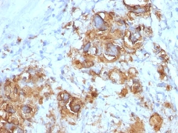 CA19-9 Antibody Gastric Carcinoma IHC. Immunohistochemistry of FFPE human gastric carcinoma tissue using CA19-9 antibody shows strong HRP-DAB brown membranous and cytoplasmic staining in tumor epithelial cells, consistent with Sialyl-Lewis A expression in gastrointestinal adenocarcinoma and mucin-associated carbohydrate antigen localization; detection was performed with clone 121SLE.