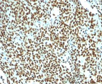 Nuclear Antigen Antibody Tonsil Germinal Center IHC. Immunohistochemistry staining of FFPE human tonsil tissue using Nuclear Antigen Antibody / Pan-Nuclear Marker Antibody (clone NM106) demonstrates intense and widespread nuclear HRP-DAB brown staining throughout densely populated lymphoid cell compartments. The staining pattern is consistent with recognition of a broadly expressed nuclear-associated antigen and highlights the nuclei of lymphocytes and other resident tonsillar cells with minimal cytoplasmic background. Strong nuclear localization provides excellent visualization of cellular density, tissue architecture, and nuclear distribution within the lymphoid microenvironment. As a pan-nuclear marker, clone NM106 is useful for identification of nuclei, assessment of cell-rich tissue regions, and evaluation of subcellular localization in histological specimens. The observed staining demonstrates robust nuclear labeling across the tonsillar lymphoid population.