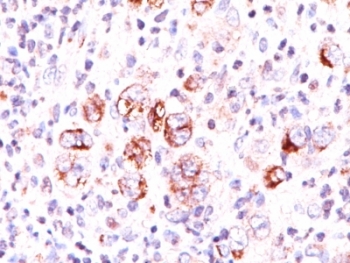 Bcl-X Antibody 2H12 Hodgkin's Lymphoma IHC. Immunohistochemistry staining of FFPE human Hodgkin's lymphoma tissue using Bcl-X Antibody (clone 2H12) demonstrates distinct cytoplasmic and membranous HRP-DAB brown staining within neoplastic cells. The staining pattern is consistent with expression of Bcl-X family proteins, including the anti-apoptotic isoform Bcl-XL, which functions to regulate mitochondrial apoptosis pathways and promote cellular survival. Bcl-X proteins are important mediators of programmed cell death regulation and have been extensively studied in hematologic malignancies due to their roles in apoptosis resistance, tumor cell persistence, and therapeutic response. The observed cytoplasmic and membrane-associated staining supports expression of Bcl-X in lymphoma-associated cellular populations.